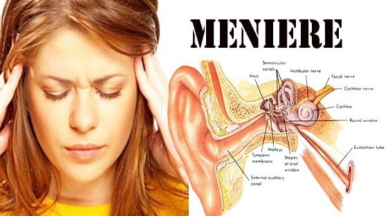apa itu penyakit meniere